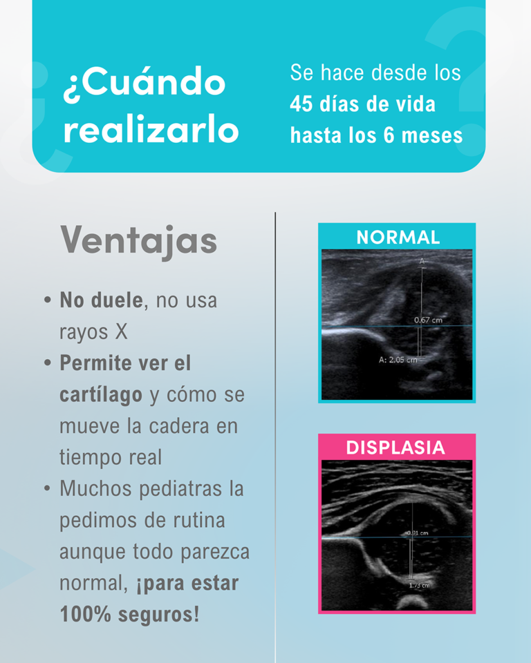2 Displacia de caderas_6